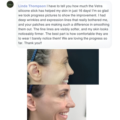 Vetra™ Scar & Wrinkle Solutions Silicone Stick