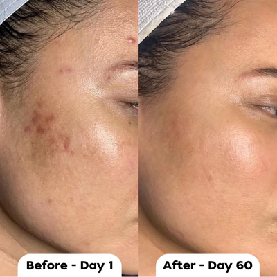 Vetra™ Silicone Scar Solutions Stick