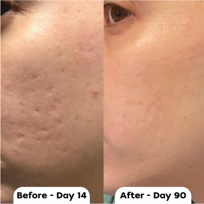 Vetra™ Silicone Scar Solutions Stick