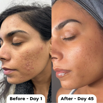 Vetra™ Silicone Scar Solutions Stick